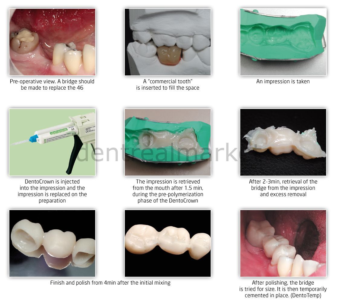 Itena Dentocrown HD Temporary Crown and Bridge Material