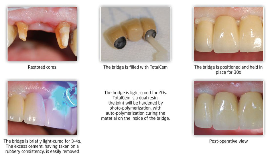 Itena TotalCem Resin-Based Cement Refill 8 g