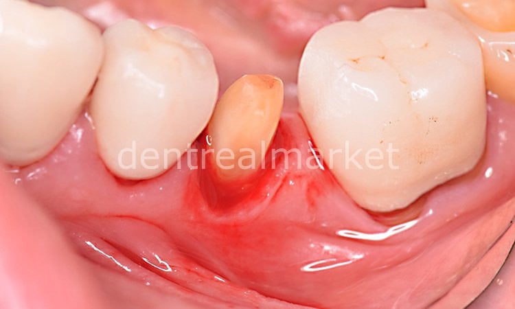 Sedenta Gingiva Gen Retraction Paste