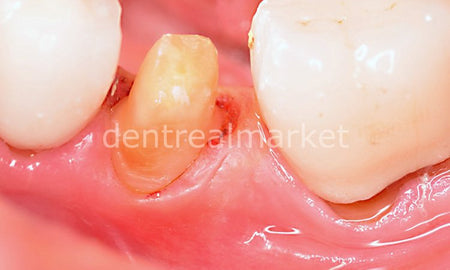 Sedenta Gingiva Gen Retraction Paste