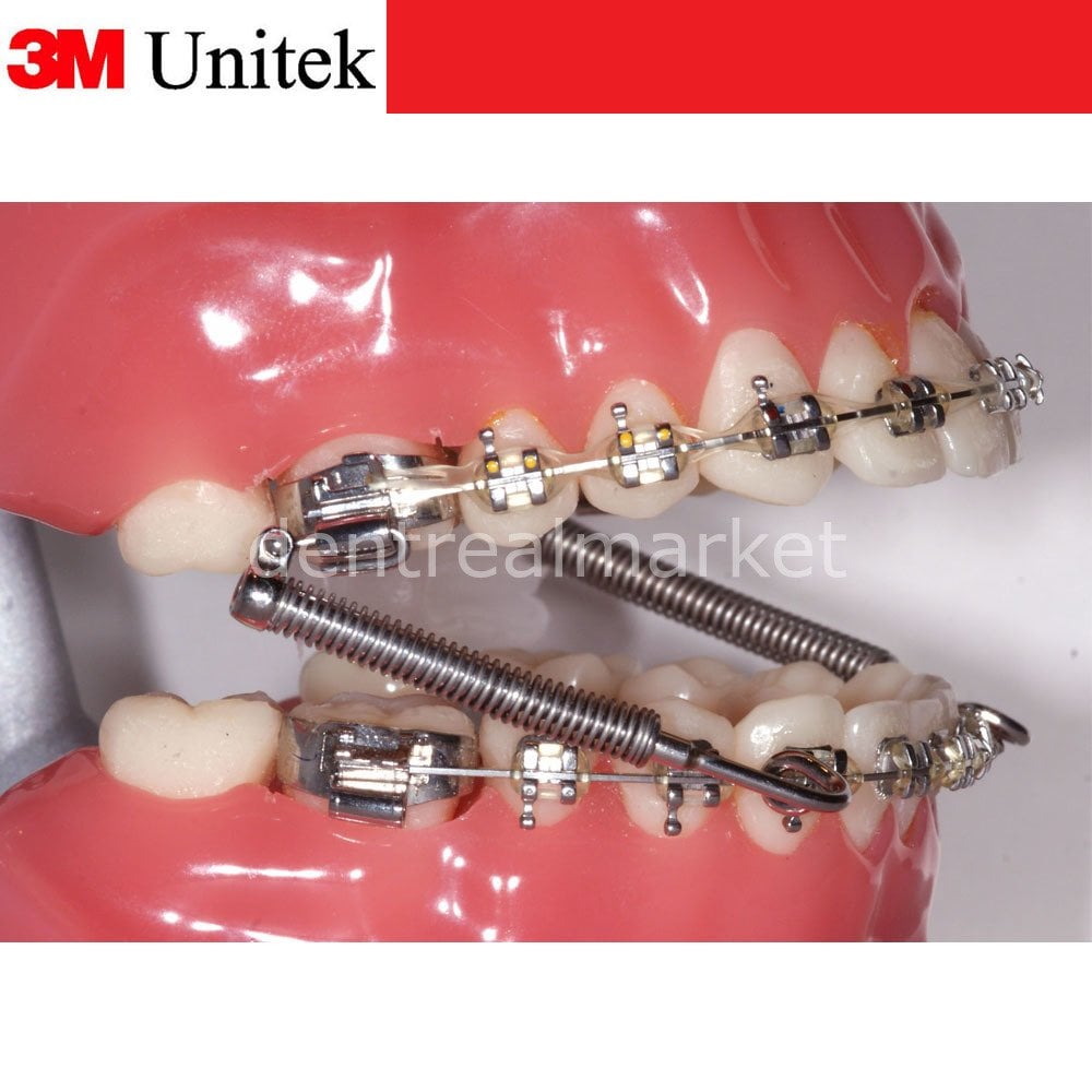 3M Unitek Forsus 5-Patient Kit