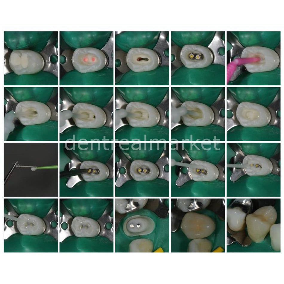 Kettenbach Visalys Core Build-Up Material