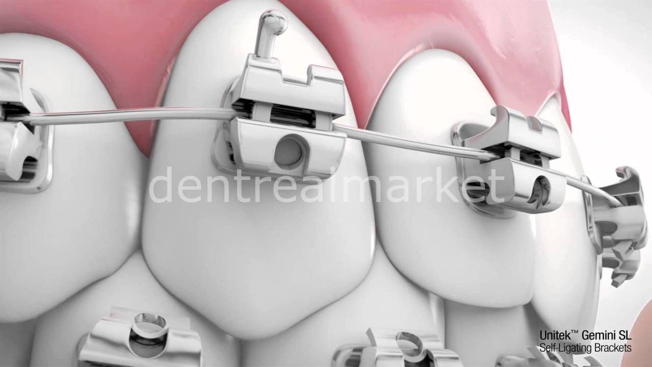 3M Unitek Gemini SL Self-Ligating Metal Bracket