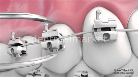 3M Unitek Gemini SL Self-Ligating Metal Bracket