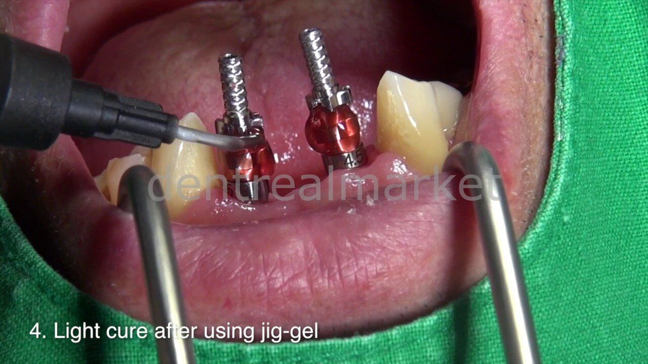 Dentreal Jig Gel Light-Cured Pattern Resin 12 ml (14 g)