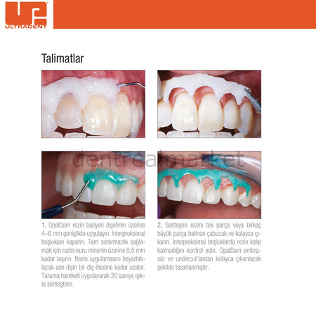 Ultradent OpalDam Gingival Barrier Kit