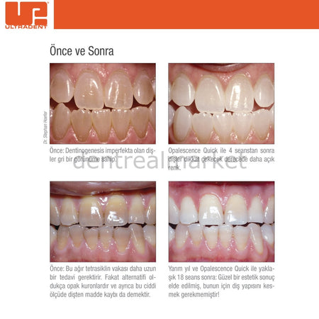 Ultradent Opalescence Quick PF 45% In-Office Whitening, 4-Pack