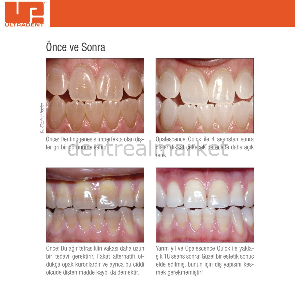 Ultradent Opalescence Quick PF 45% Refill Office Whitening 20 pcs