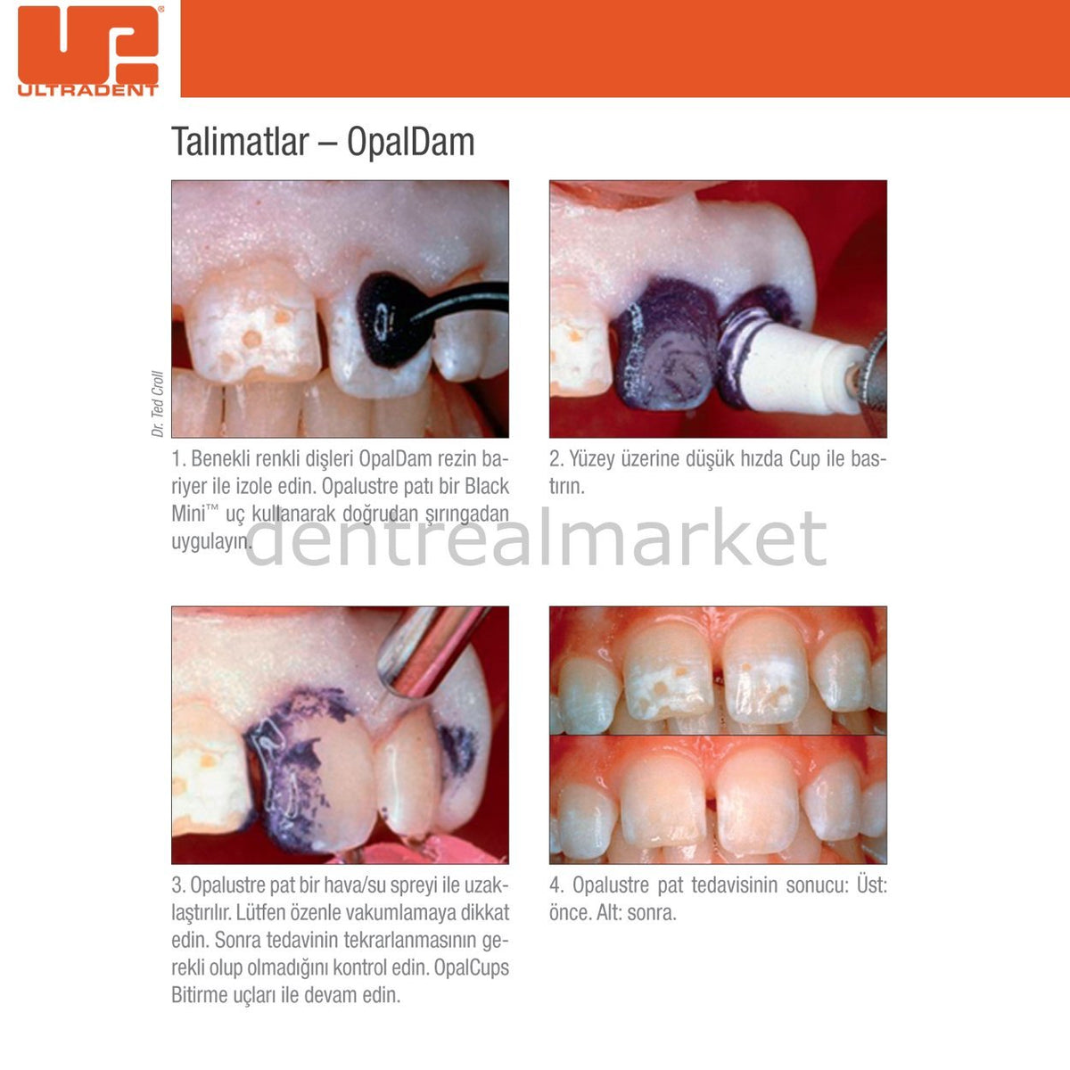 Ultradent Opalustre Whitening for Fluorosis-Stained Teeth, Pack of 2