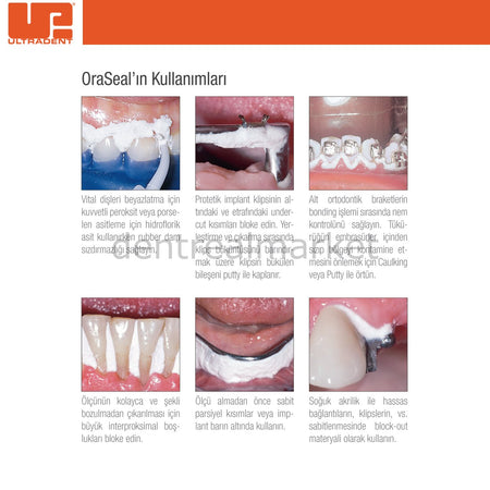 Ultradent OraSeal Caulking and Putty Kit