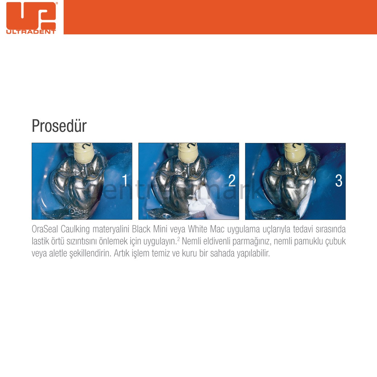 Ultradent OraSeal Caulking Refill