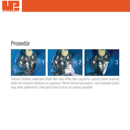 Ultradent OraSeal Caulking Refill