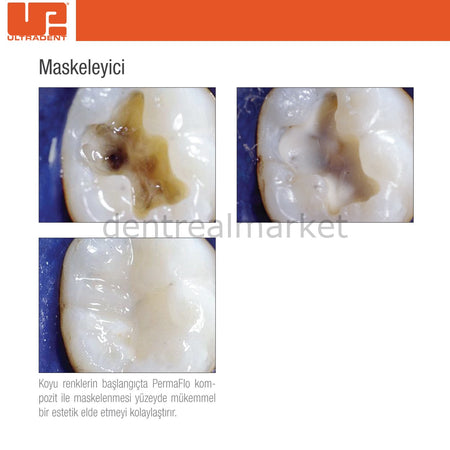 Ultradent PermaFlo Flow Dentin Opaquer Flowable Composite Refill