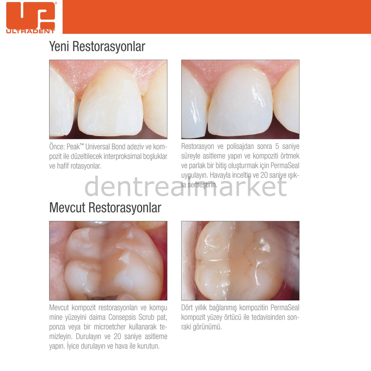 Ultradent PermaSeal Resin Surface Sealant Kit
