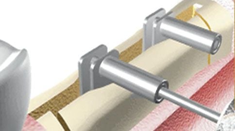Meisinger Crest Control Bone Expander Kit