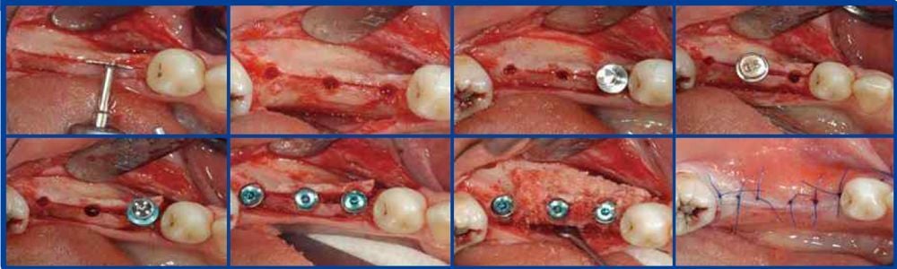 Surgident Bone Expander Drill Kit