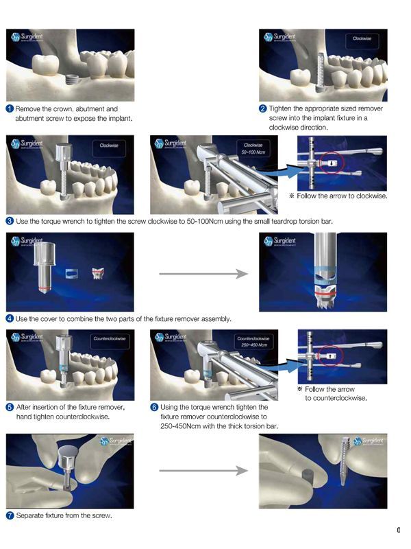 Surgident Single Out Implant Removal Set