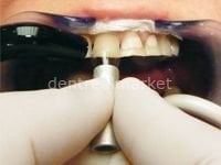 Polydentia Cervical Former Matrix Refill