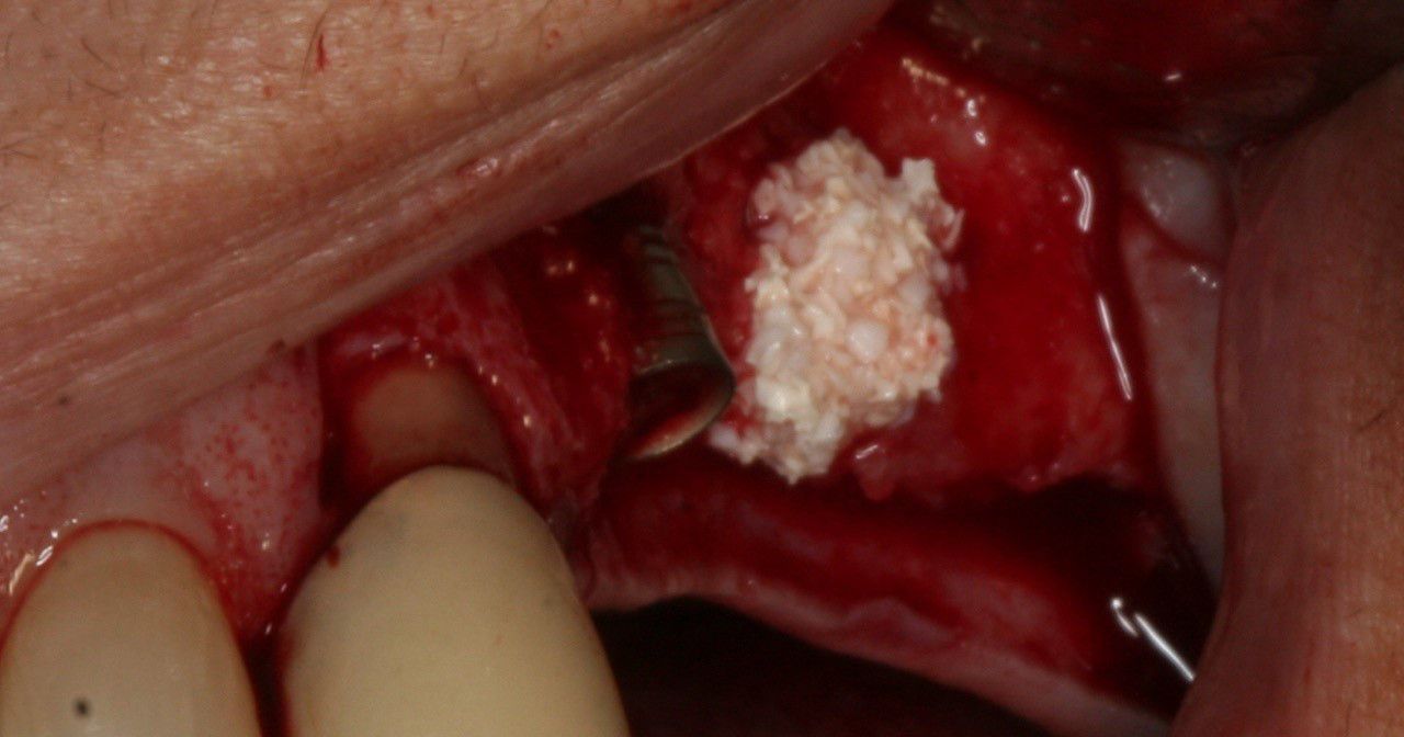 Resorba Parasorb Collagene Cone - Extraction Socket Protection