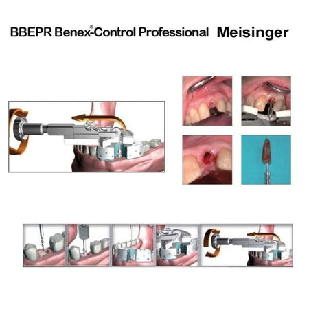 Meisinger Benex Control Basic Root Extraction System