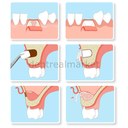 Resorba Parasorb Resodont Forte - Collagen Membrane 32*25 mm