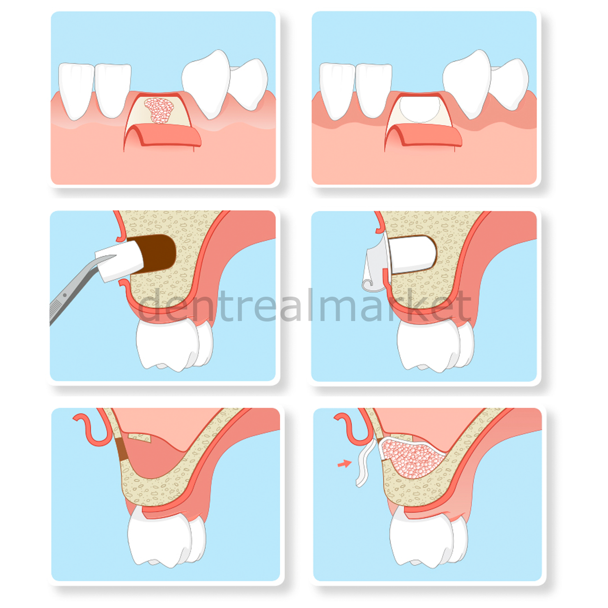 Resorba Parasorb Resodont Forte - Collagen Membrane 64*25 mm