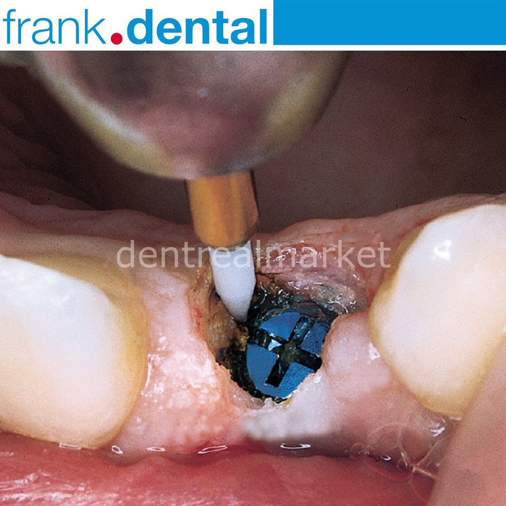 Frank Dental Gingiva Trimmer Soft Tissue Bur STT249